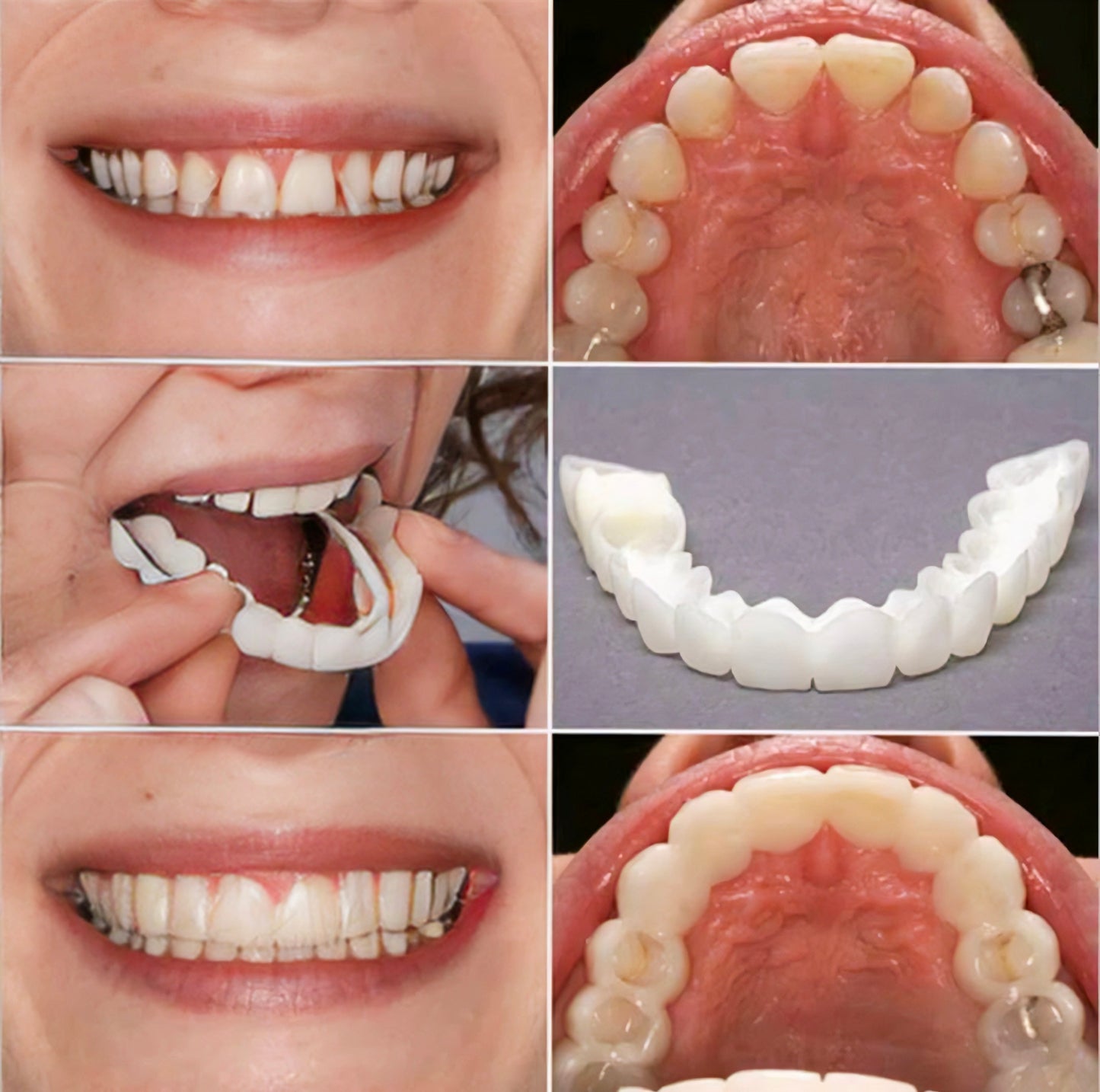 Teeth Brace Temporary Teeth Braces Cover