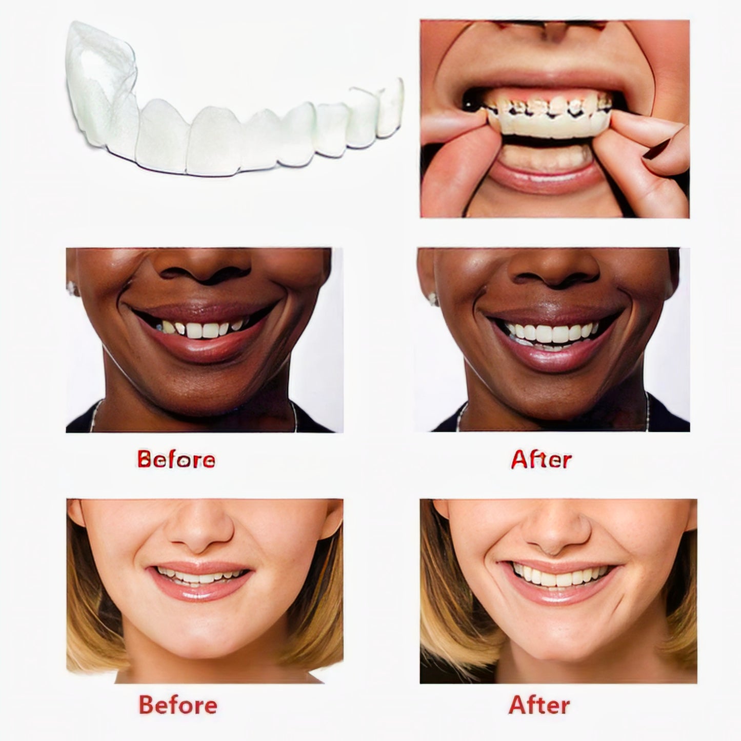 Teeth Brace Temporary Teeth Braces Cover