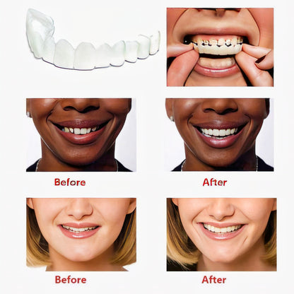 Teeth Brace Temporary Teeth Braces Cover